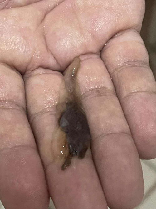 Jelly like na parang may blood