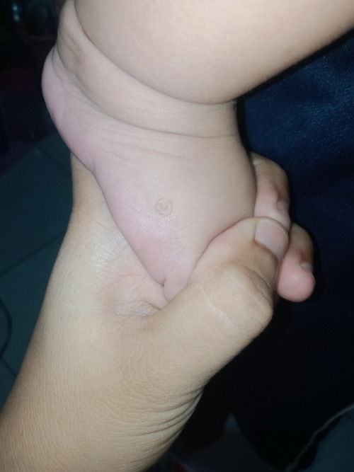 Bercak di kaki bayi