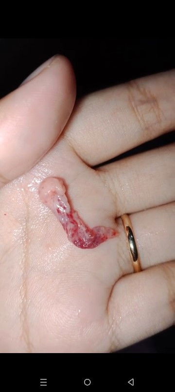 Bun mau tanya ada GK yg Ngalamin kyk aku Abis SC ,9 bulan baru menstruasi dan baru KB suntik 3 bln