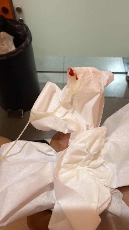 Keputihan pada tm1 kehamilan