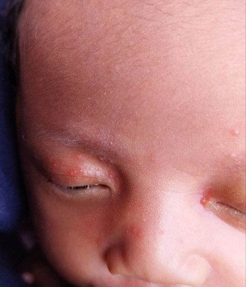 mata blobok an atau ada kotorannya