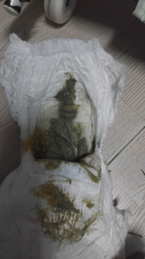 ลูก4เดือน10วัน อึแบบนี้ผิดปกติไหมคะ