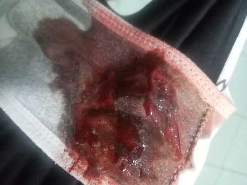 มีเลือดออกแบบนี้เค้าเรียกว่าตกเลือดมั้ยคะ ตอนแรกหนูตกใจนึกว่าเป็นปจดแต่ไม่ใช่อะค่ะ