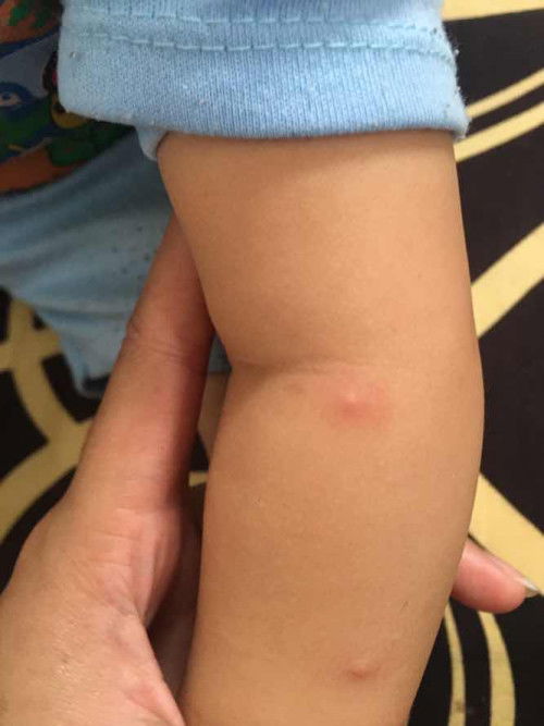 Bintik kecil di area tangan, kaki, kepala