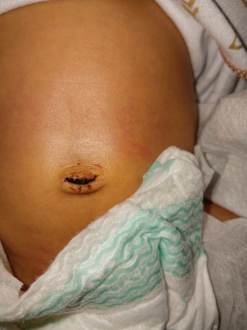 Setelah 9hari puput pusar, ini normal ga ya bun? Sebelumnya biasa aja ngga keluar hitam"nya