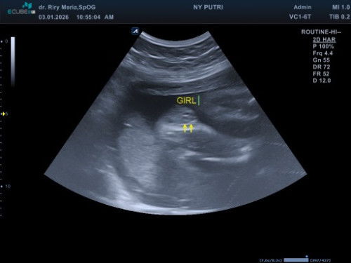 Bunda" Mau tanya apa ini benar jenis kelamin nya perempuan ya, usia kandungan 28 minggu