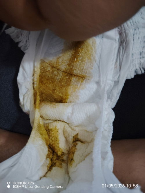 Ano po common signs na nagngingipin na si baby? Lagnat? Nagtatae? Matamlay? Ano po experience niyo?