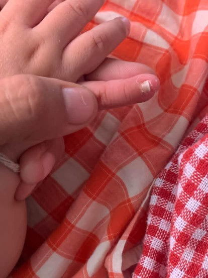 เล็บลูกเหมือนจะหลุด