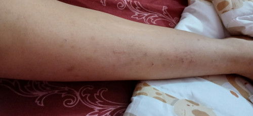 Pasca melahirkan gatal-gatal