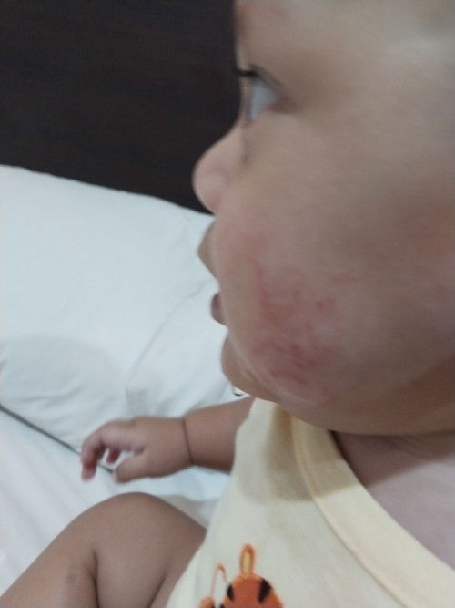 ruam merah pipi bayi