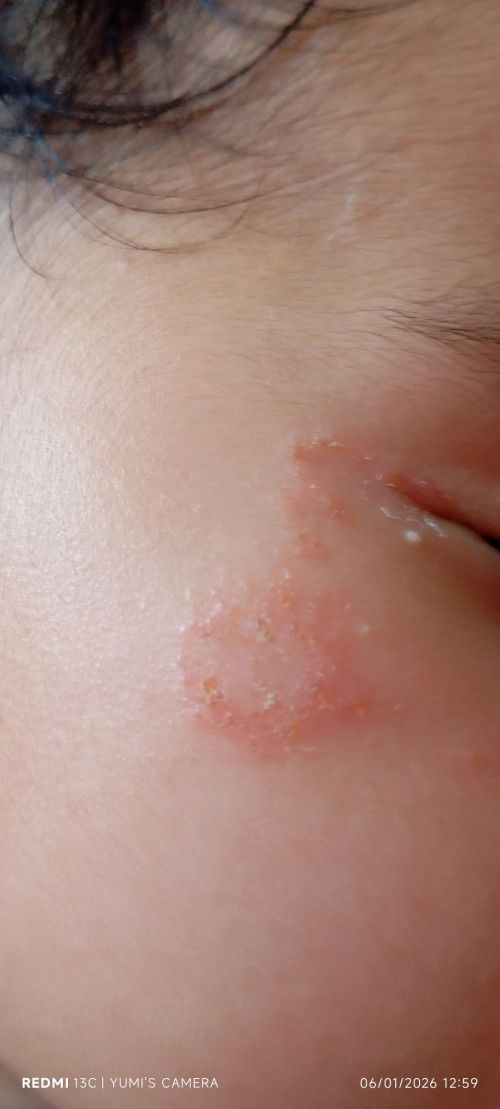 Ano remedy pinapahid niyo dito mga mii?