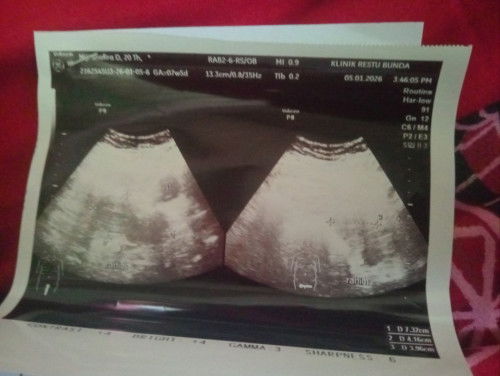 Bun ada yng bisa ngtahui ini sudah hamil belom ya? Katanya belom keliatan kantung kehamilan.
