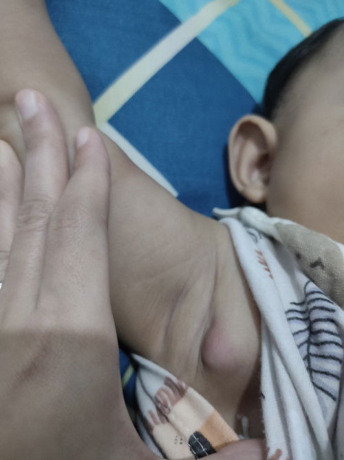 Benjolan di ketiak bekas imunisasi BCG