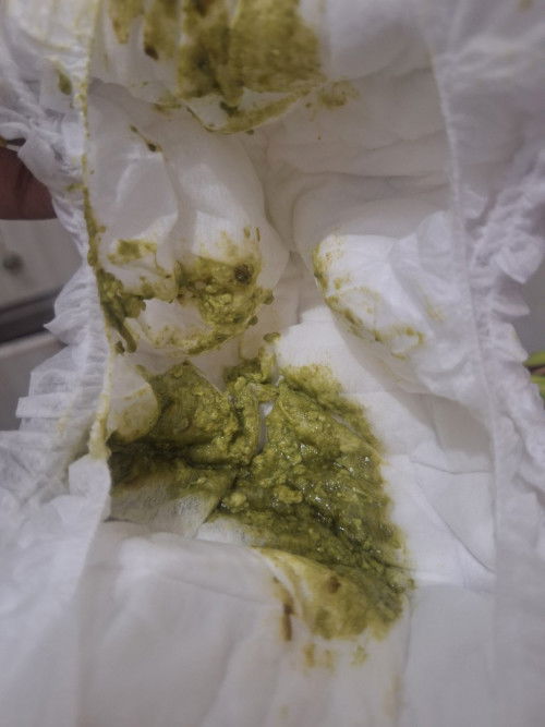 Bayi umur 4 bulan udah seminggu BAB warna hijau