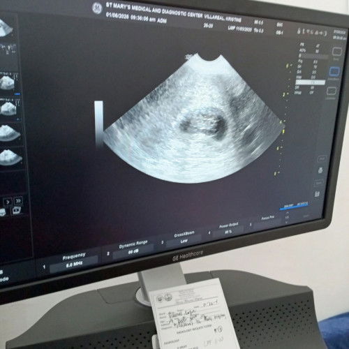 Last March 26,2025 i lost my baby at 7weeks in 5 days.. sobrang sakit kasi iyun yung unang anak ko.