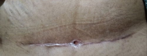 Luka bekas SC bolong