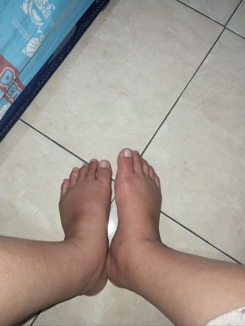 Apakah bahaya Kaki bengkak usia kehamilan 34 minggu ?