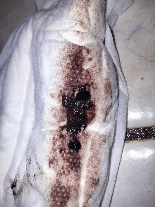 Ganto din ba dscharge nyo 9 weeks   nakunan na  pang 3days ko na genyan dscharge 🥲