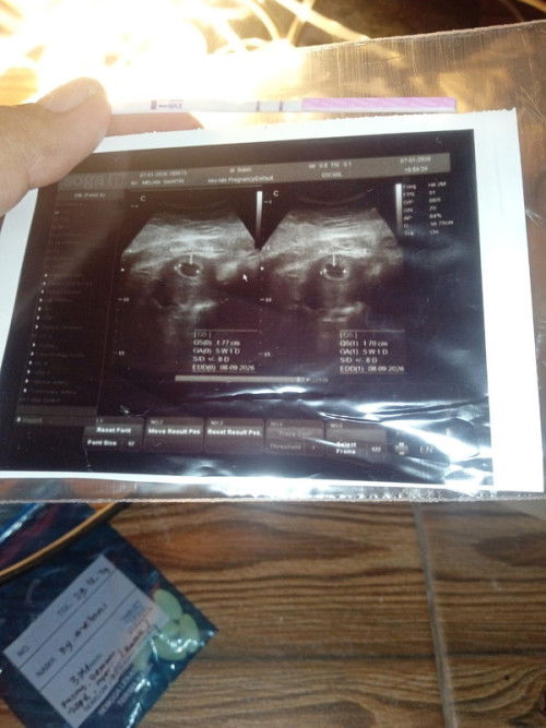 Hpht pertengahan November tapi usia kehamilan baru 5 minggu