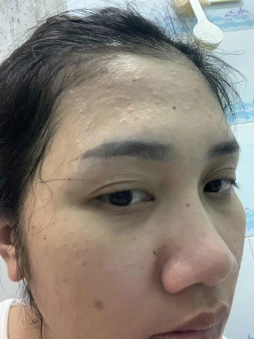 อายุครรภ์ 35สัปดาห์