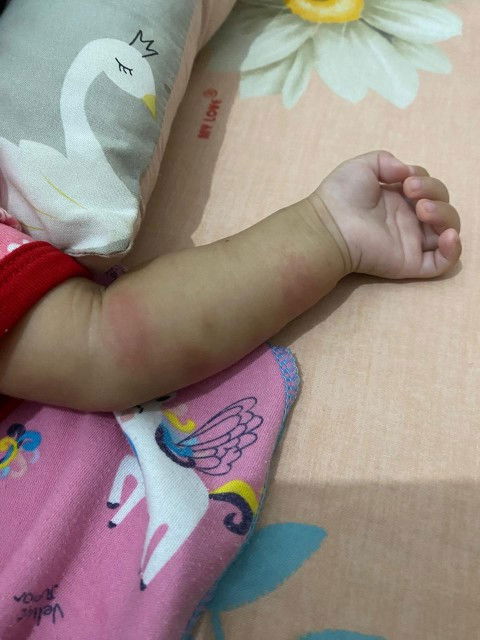 Bekas gigitan nyamuk