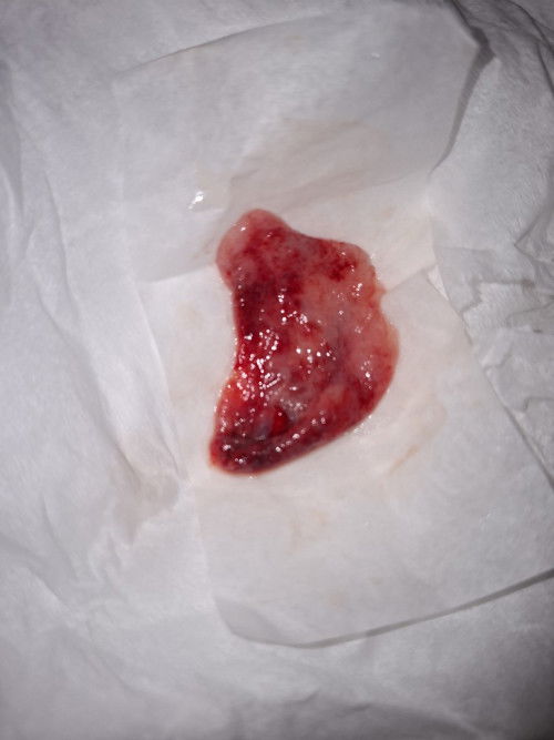 Mau tanya dong bunda"Kmrin saya flek trus tdi pagi kluar kaya jaringan gitu,itu jaringan janin/bukan