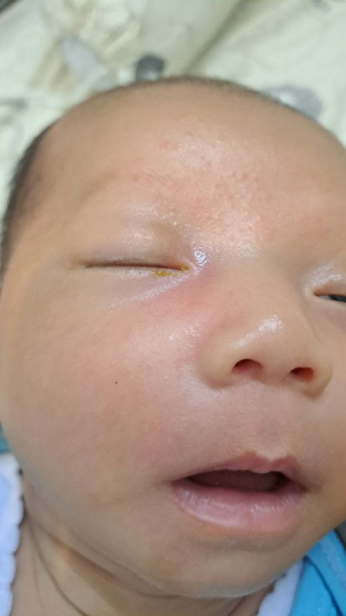 Mata anak sering belekan