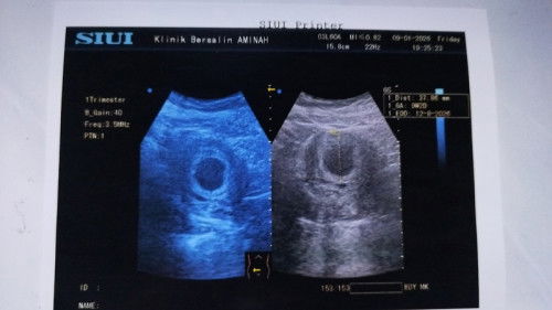 Usia kandungan 9-10 weeks