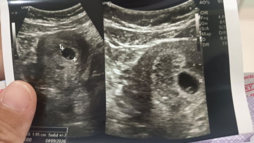 USG 5w6d kantung yolk sac tidak bulat sempurna