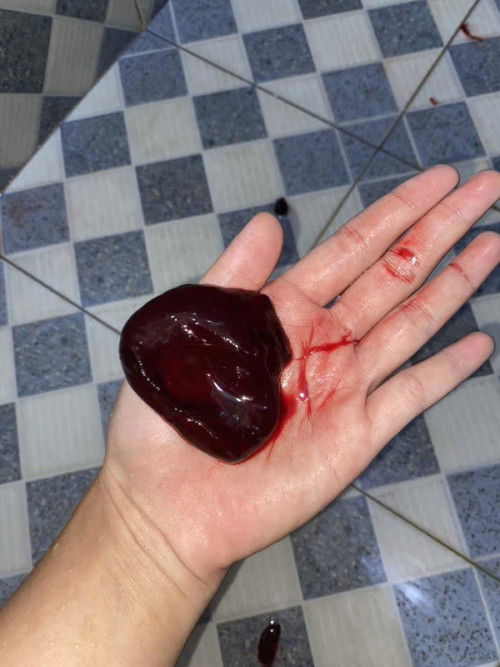 Hamil Bo,keluar gumpalan darah