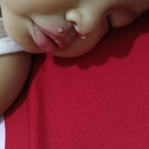 Ada yang anaknya pernah muncul gini ga bunda? Pake apa ya?