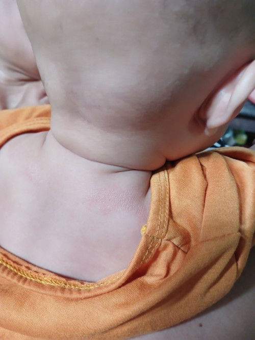 Kulit kering bahu belakang bawah leher