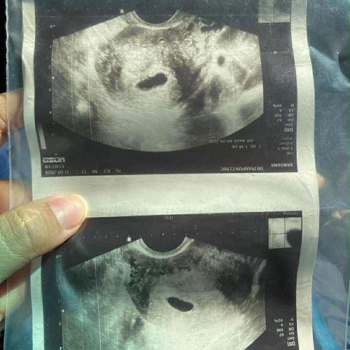 มีแม่ๆบ้านไหนไปซาวน้องตอน8สัปดาห์แล้วไม่เจอน้องบ้างคะ