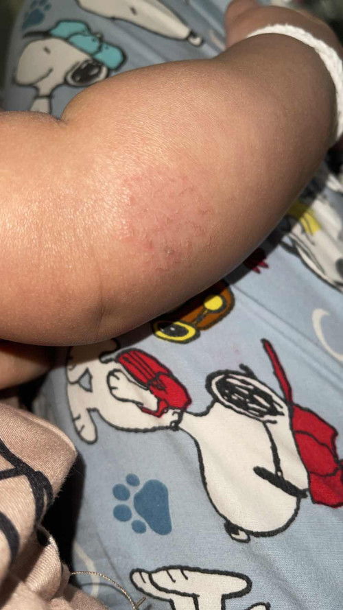 ลูกมีผื่นขึ้นแบบนี้ ขอคำแนะนำหน่อยค่ะ