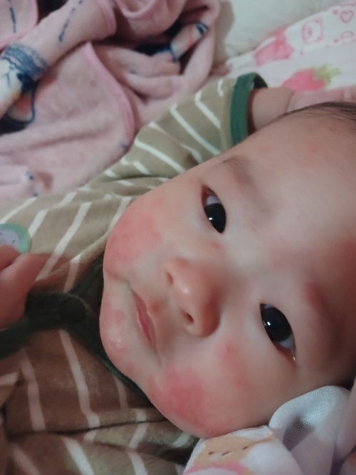 ผื่นขึ้นบนหน้าเหมือนหน้าลอก