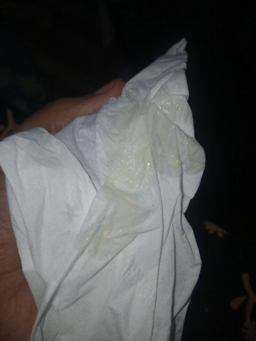 Ini keputihan bukan ya bun, baru keluar pas masuk tm 3 ini, apa msh normal?