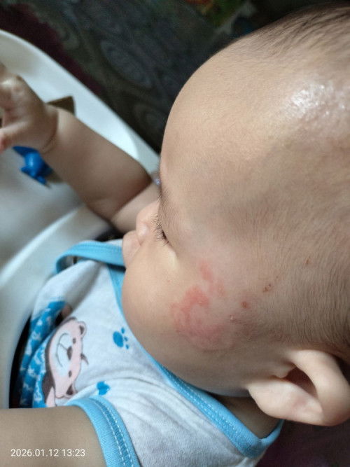 Kemerahan di sebelah mata