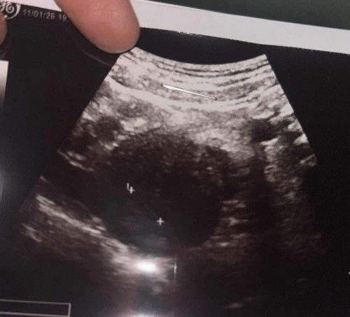 ตั้งครรภ์มีเลือดออก