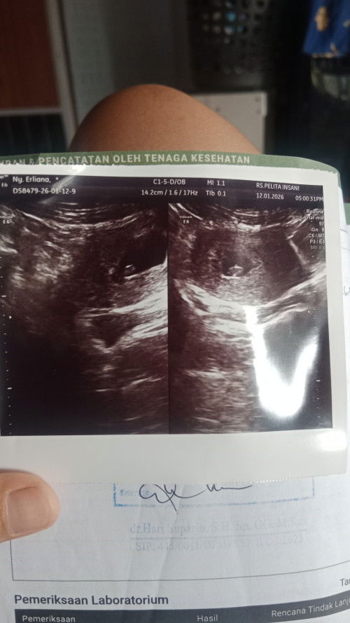 Hasil usg,adabyg pengalaman ga tentang hamil muda keluar darah bnyk banget.