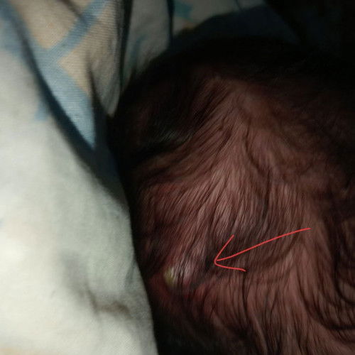 Benjolan bernanah seperti bisul