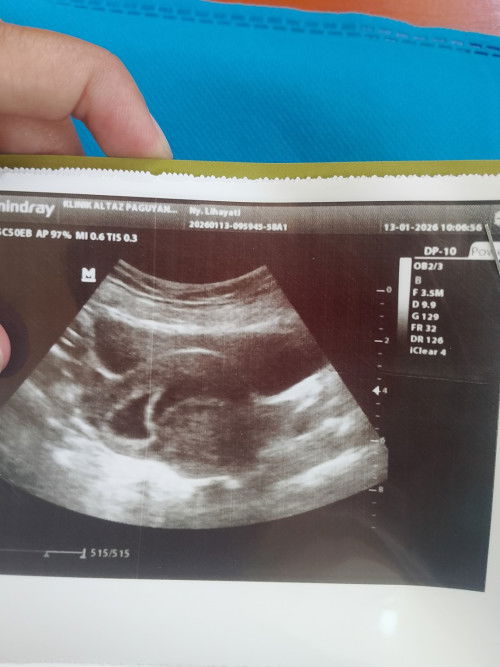 saya udh usg stlh pendarahan kemaren ternyata masih kantong dan ada bulatan samar dirahim 😭