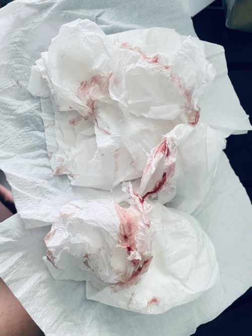 อายุครรภ์ 39+3