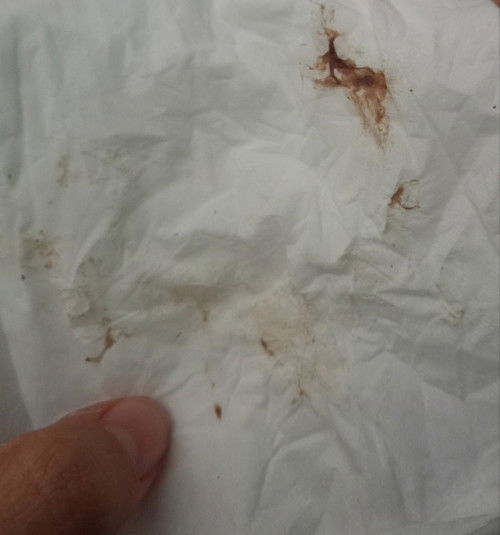 ตกขาวอย่างนี้ผิดปกติไหม