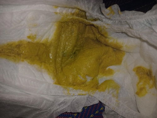 ถ่ายแบบนี้ปกติไหมคะ