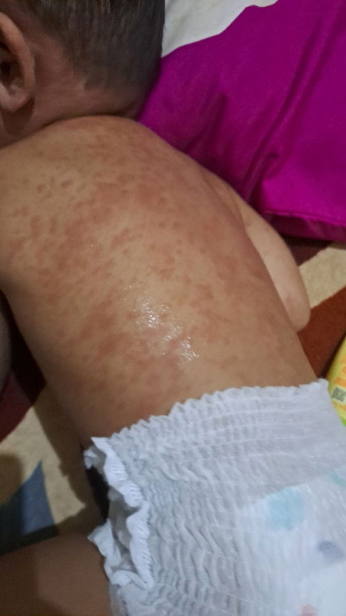 Bun,abis dilap air kelapa sama dimnum kluar semua keremut / campak boleh gk dipakain bedak / lotion?