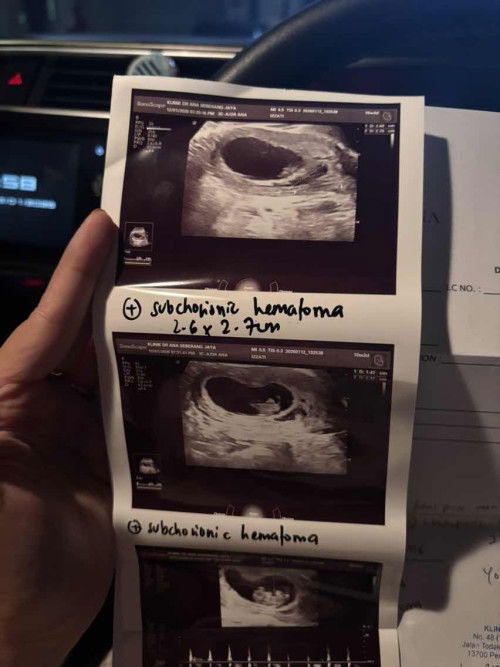 Subchorionic Hematoma Diagnose