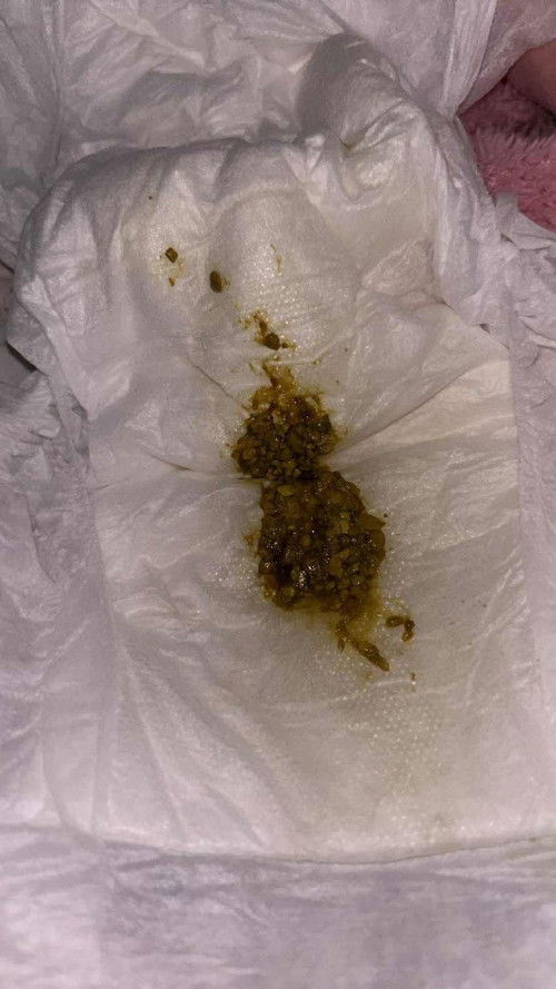 ลูกอึลักษณะแบบนี้ผิดปกติไหมคะ