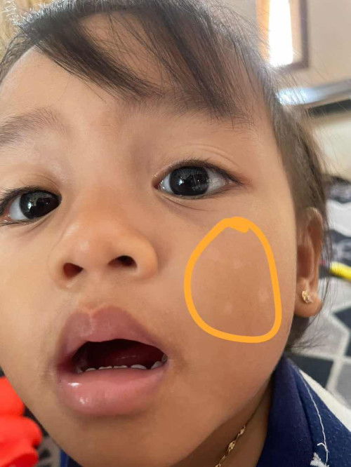 Obat panu yang ampuh untuk ank usia 2 tahun , apa ya?