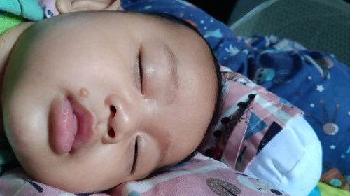 Bekas gigitan nyamuk dari bentol kayaka jerawat