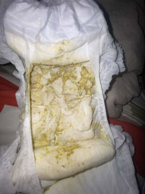 ลูก11เดือน อึเป็นแบบนี้ปกติมั้ยคะ น้องอึวันนี้ประมาณ2-3รอบสีแบบนี้ ( สีจริงจะอ่อนกว่าในรูปนะคะ)